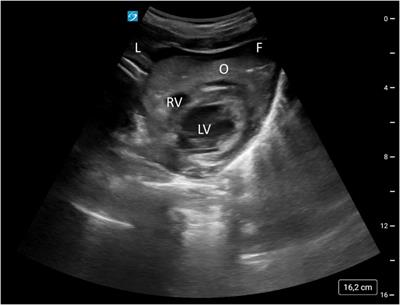 Case Report: Traumatic cardiac arrest due to pericardial tamponade: successful pericardiocentesis with a Shaldon catheter